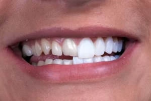 Kaplamanın Altındaki Diş Çürürse Ne Olur?