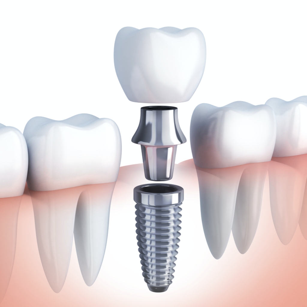 Implant